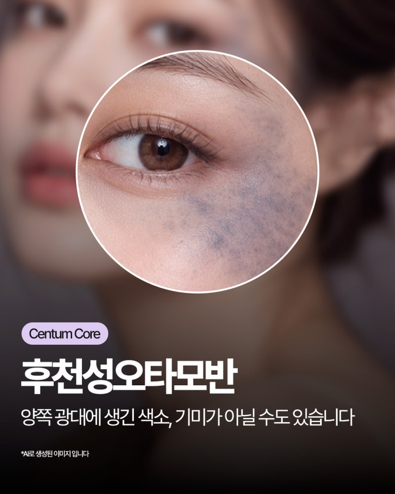 해운대오타모반,앙쪽 광대에 비슷한 색소가 생겼다면?후천성오타모반 알아보기