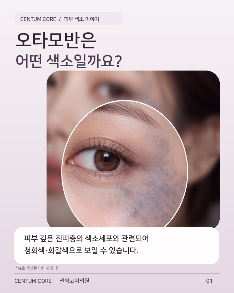 해운대오타모반,앙쪽 광대에 비슷한 색소가 생겼다면?후천성오타모반 알아보기 사진 2