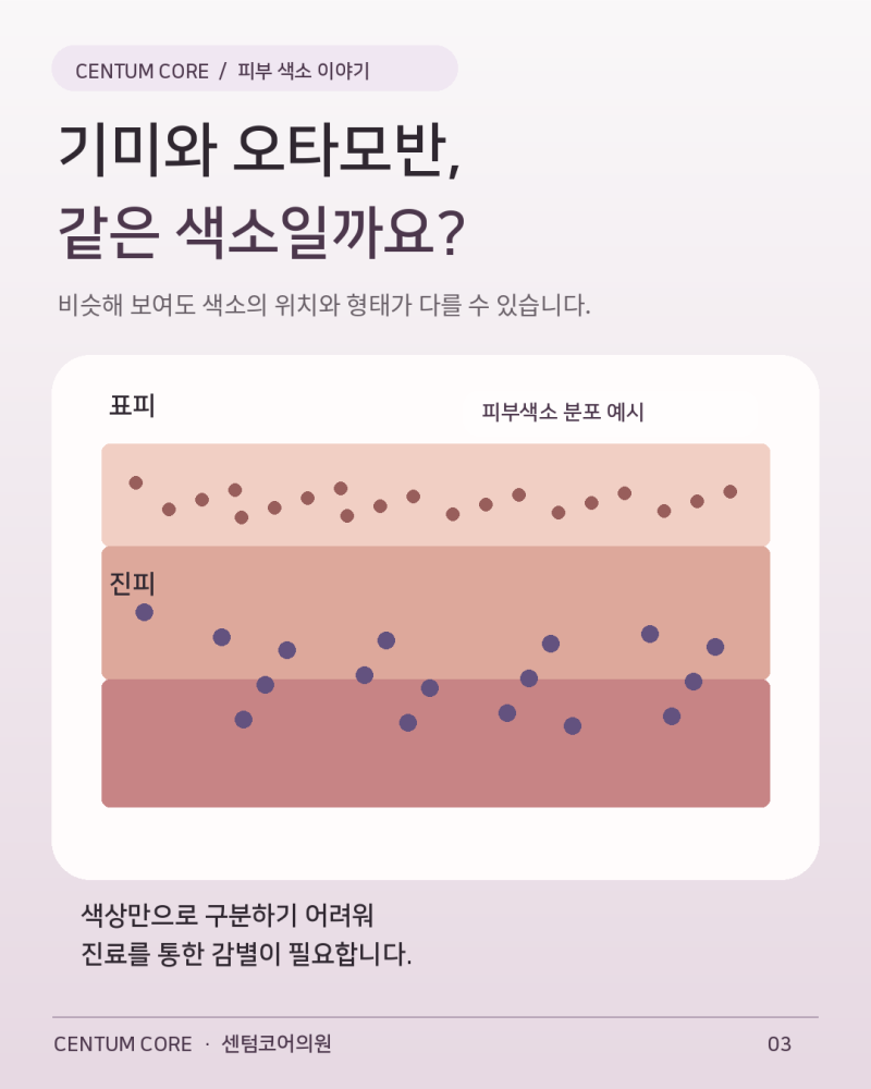 해운대오타모반,앙쪽 광대에 비슷한 색소가 생겼다면?후천성오타모반 알아보기 사진 4