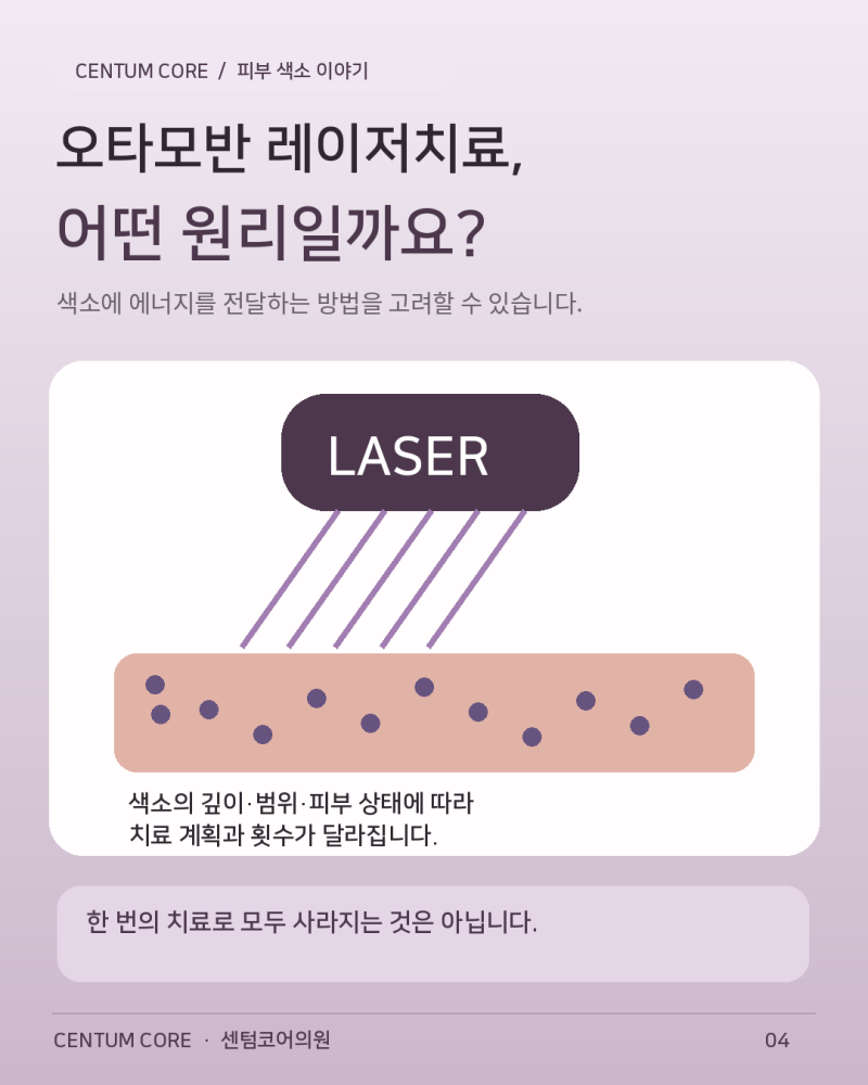 해운대오타모반,앙쪽 광대에 비슷한 색소가 생겼다면?후천성오타모반 알아보기 사진 5
